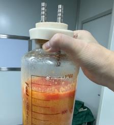 迁西水动力吸脂手术要做多久？